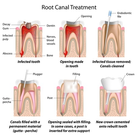 6 different tooth pics illustrating a root Canal